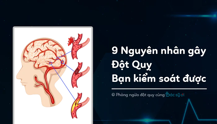 9 nguyên nhân đột quỵ